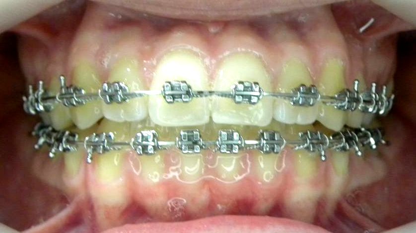 Frontal (Oclusión)