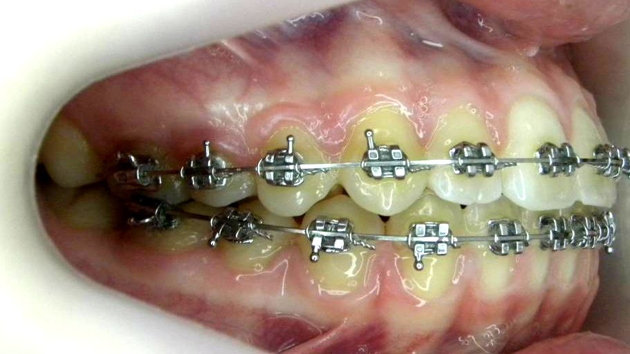 Lateral Derecha