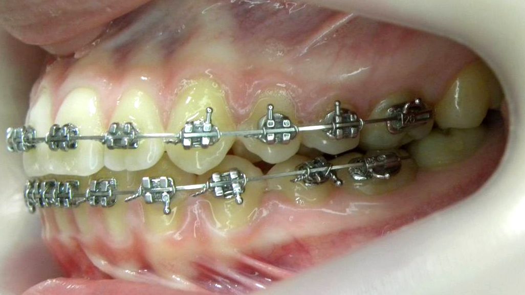 Lateral Izquierda