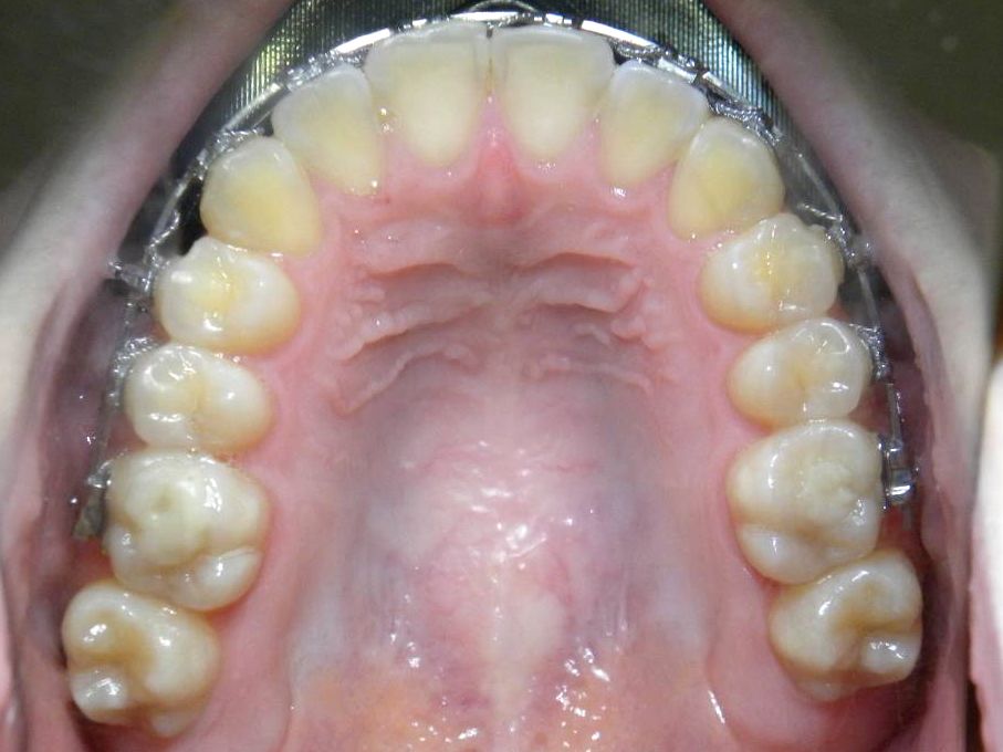 Oclusal Superior