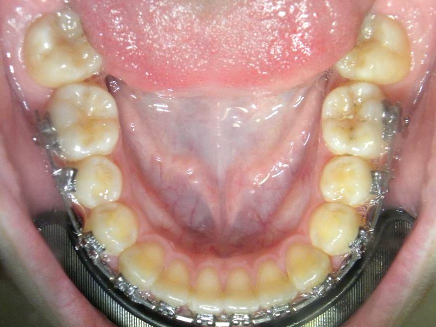 Oclusal Inferior