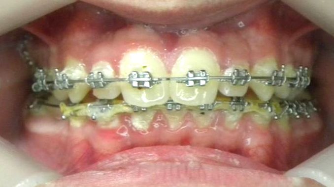 Frontal (Oclusión)
