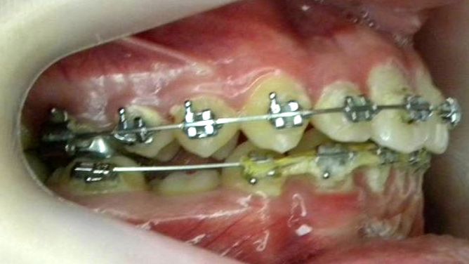 Lateral Derecha
