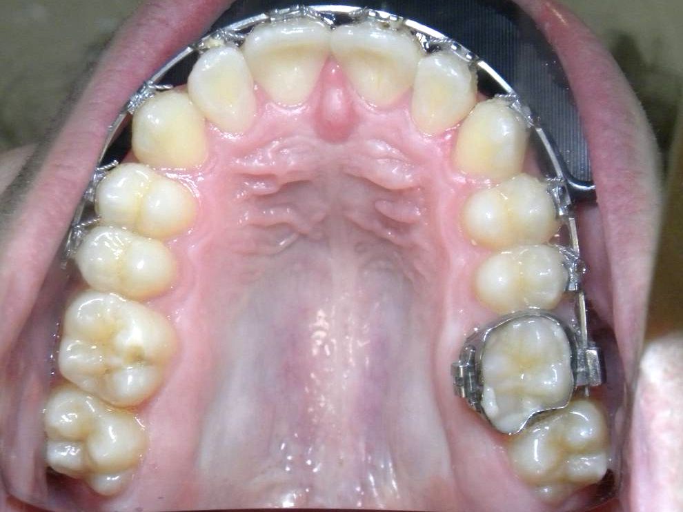 Oclusal Superior