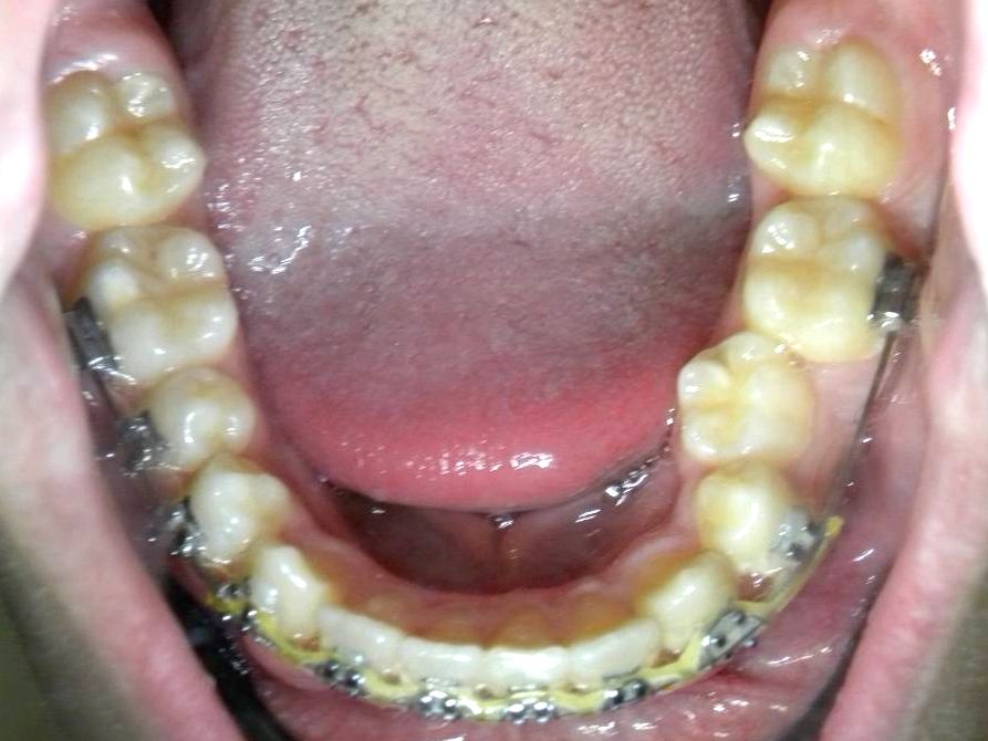 Oclusal Inferior