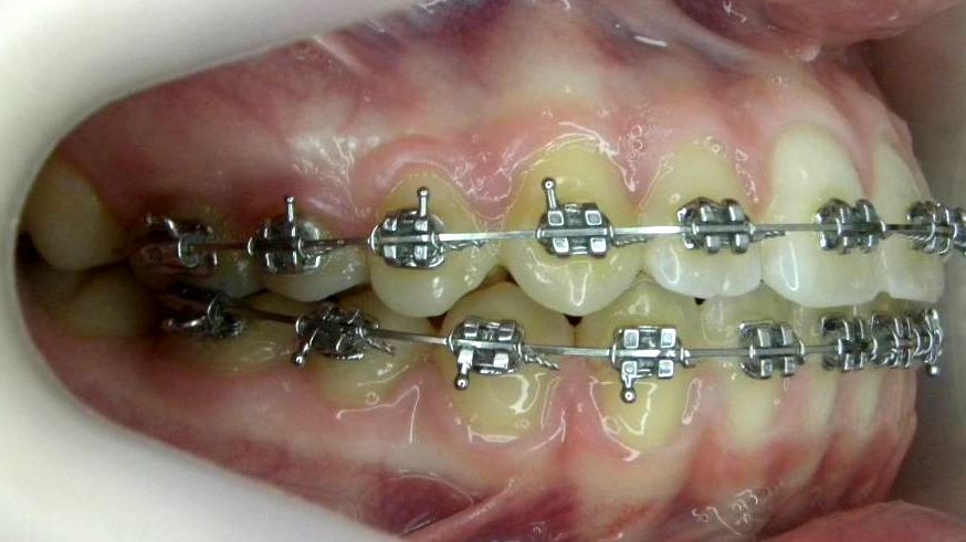 Lateral Derecha