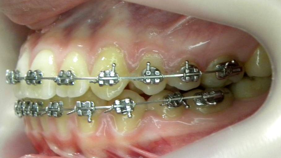 Lateral Izquierda
