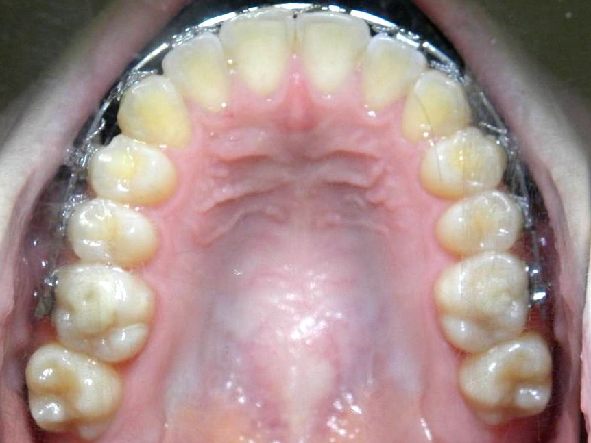 Oclusal Superior