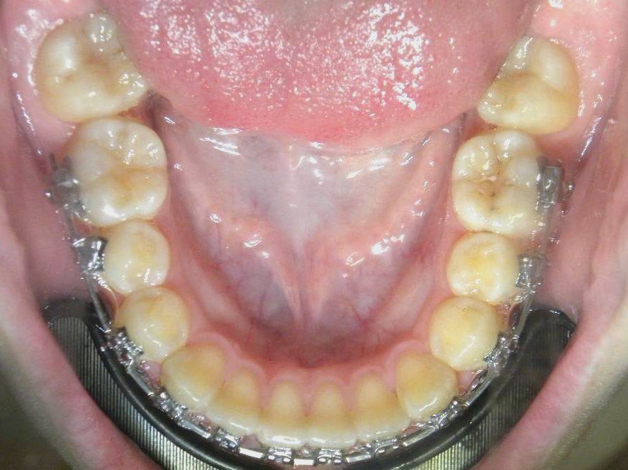 Oclusal Inferior