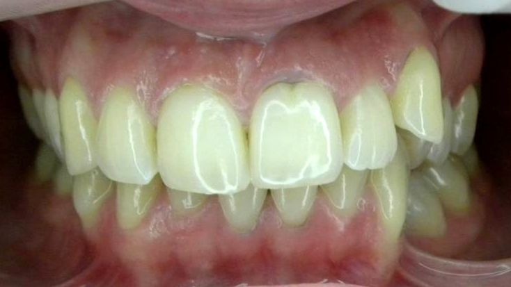 Frontal (Oclusión)