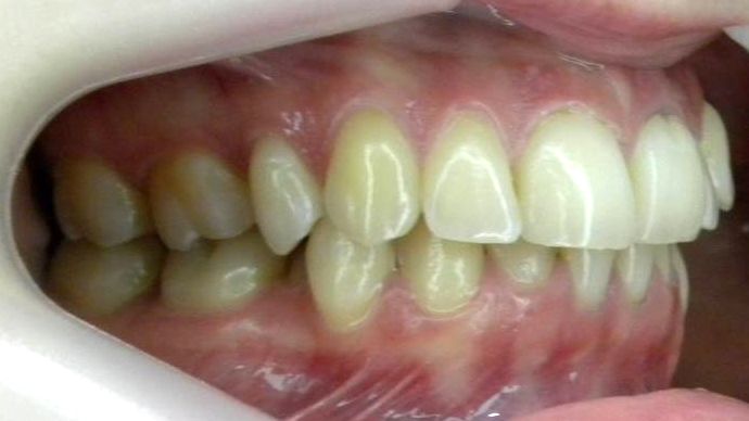 Lateral Derecha