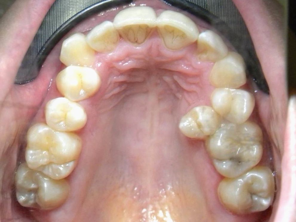 Oclusal Superior