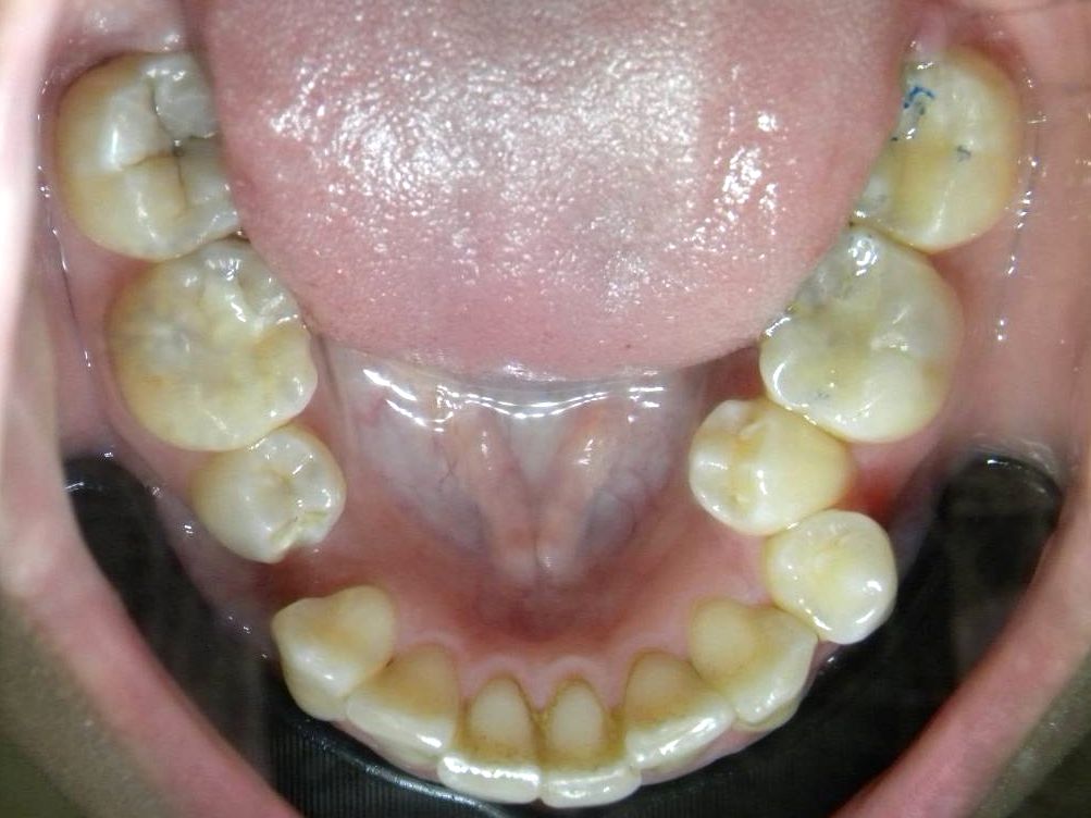 Oclusal Inferior