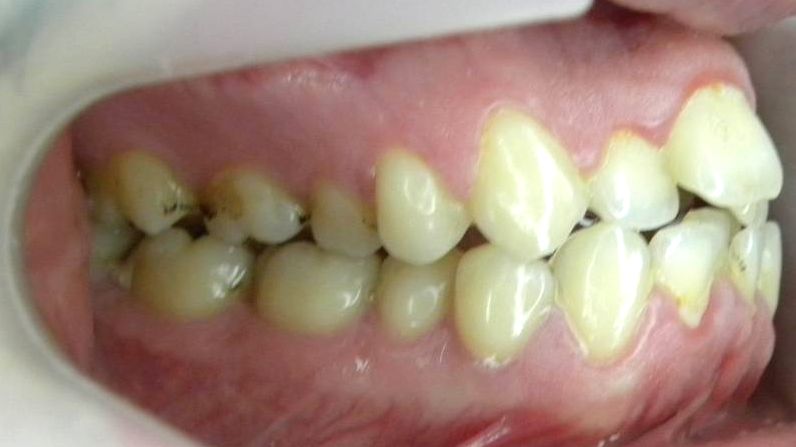 Lateral Derecha