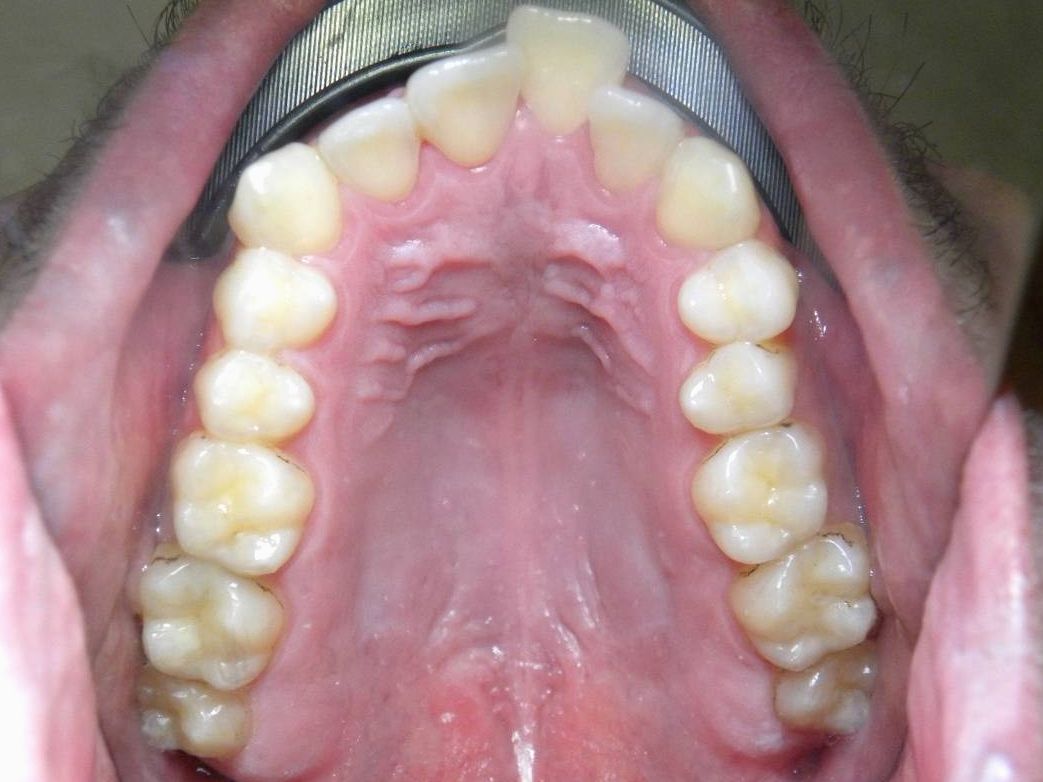Oclusal Superior