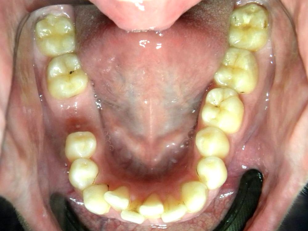 Oclusal Inferior