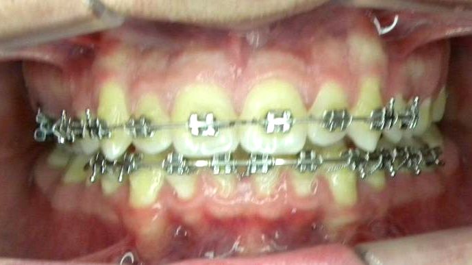 Frontal (Oclusión)