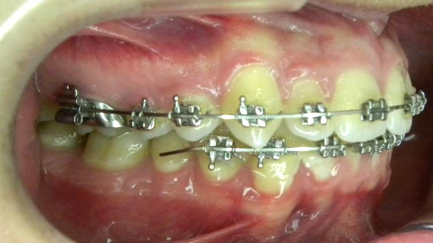 Lateral Derecha