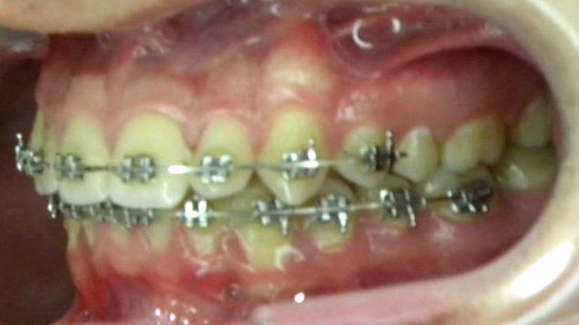 Lateral Izquierda