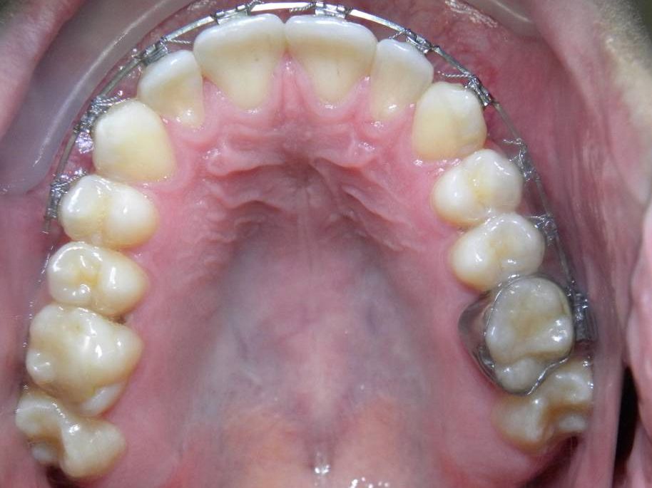 Oclusal Superior