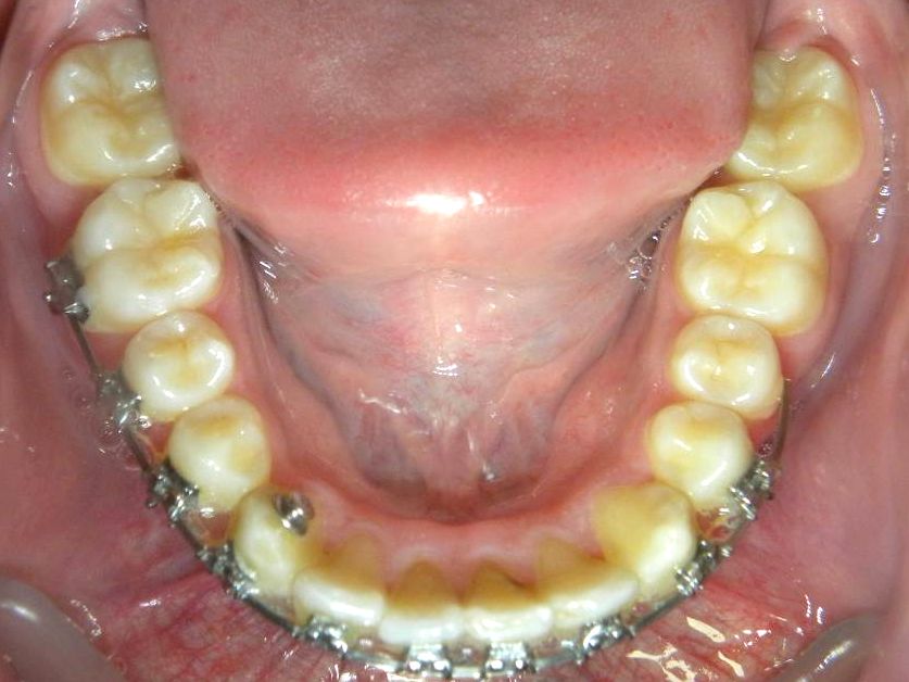 Oclusal Inferior