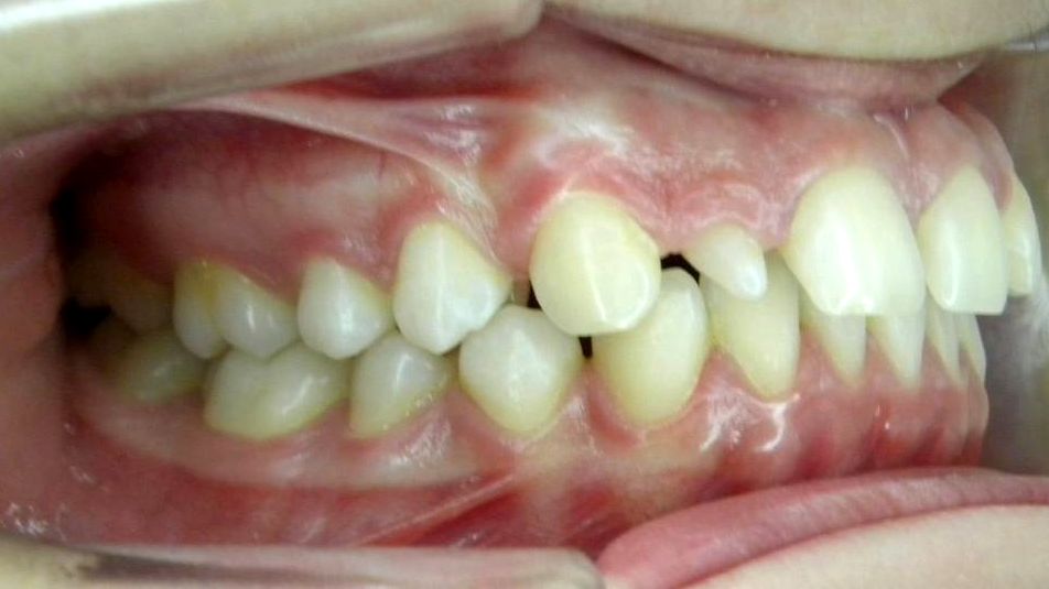 Lateral Derecha