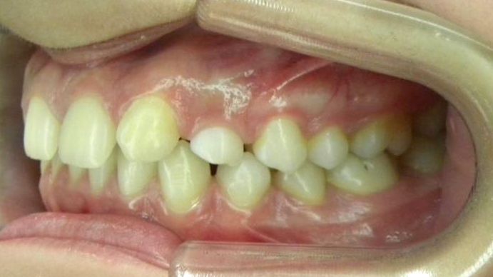Lateral Izquierda