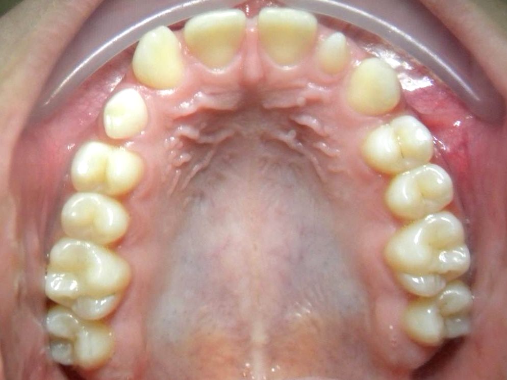 Oclusal Superior