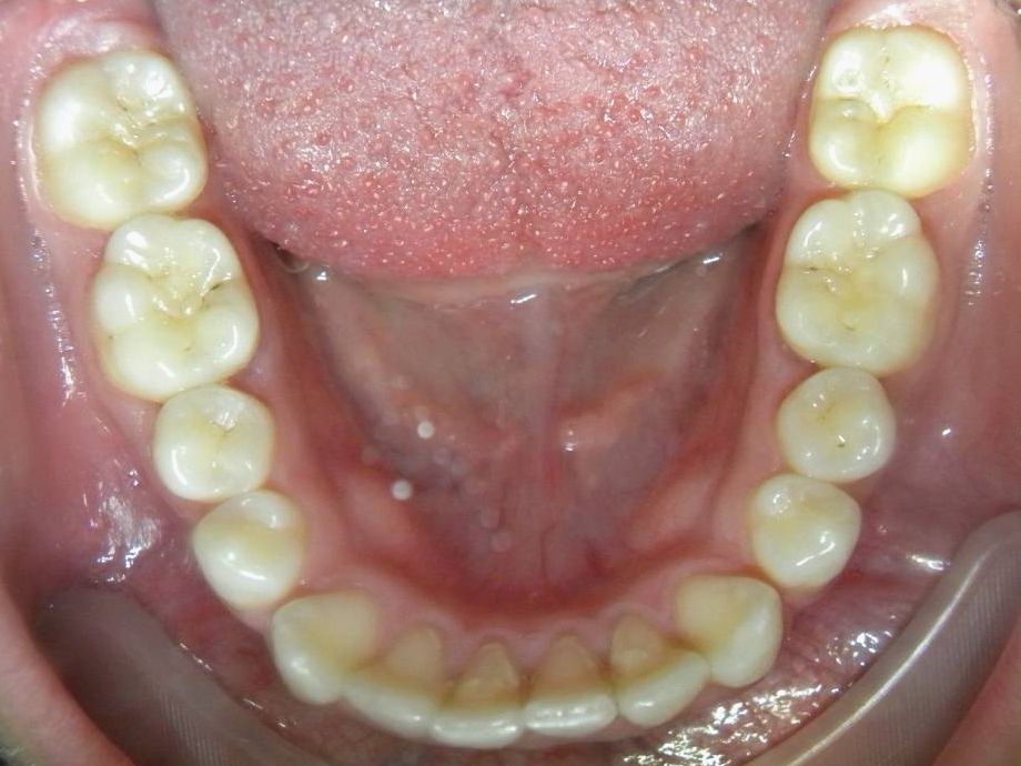Oclusal Inferior