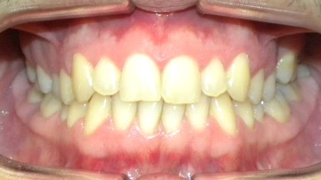 Frontal (Oclusión)