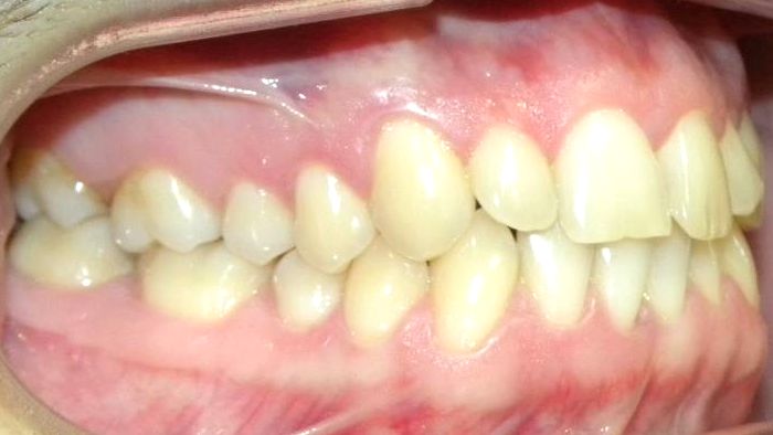 Lateral Derecha