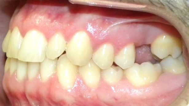Lateral Izquierda