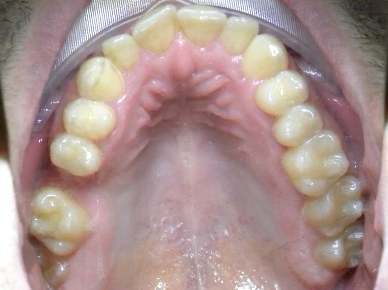 Oclusal Superior