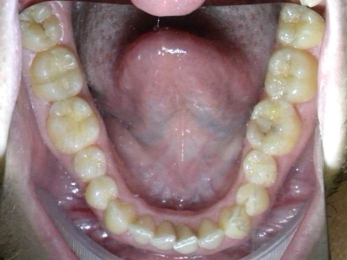 Oclusal Inferior