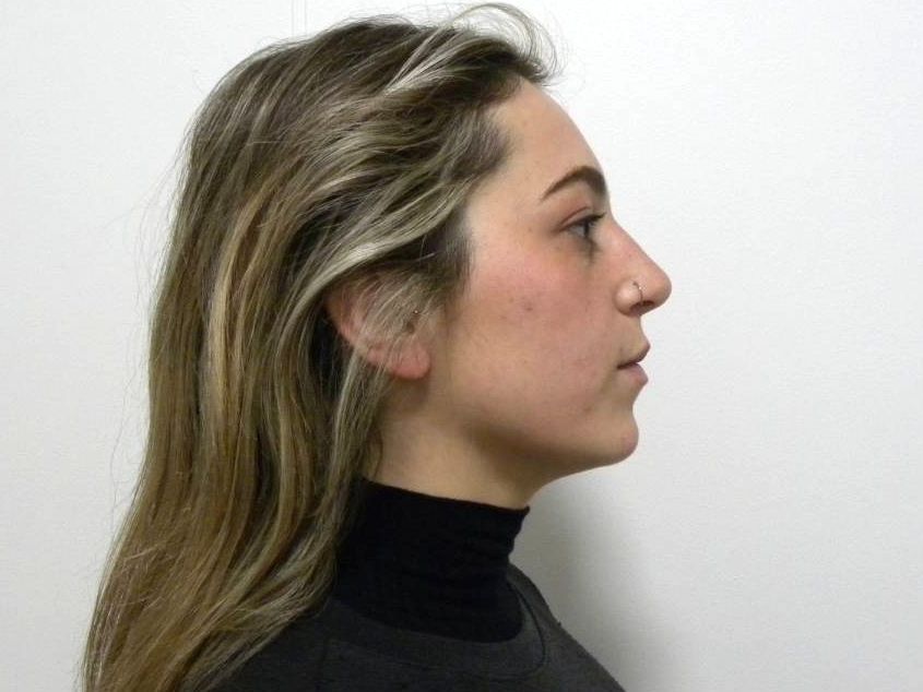 Lateral estricta derecha
