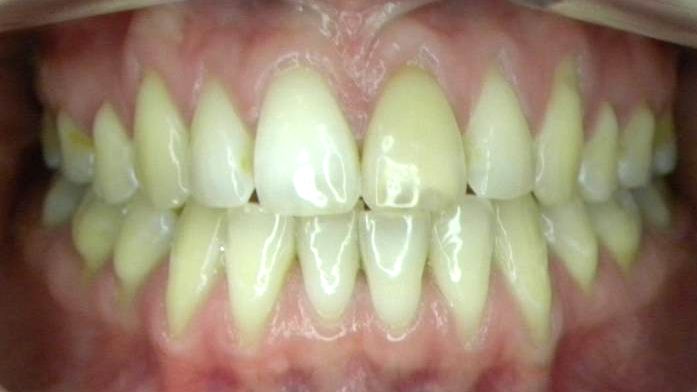 Frontal (Oclusión)