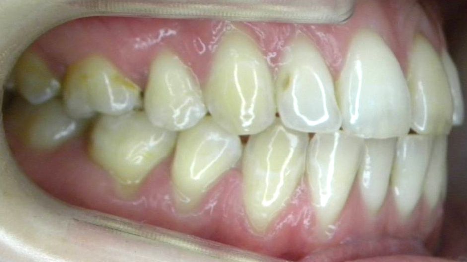 Lateral Derecha