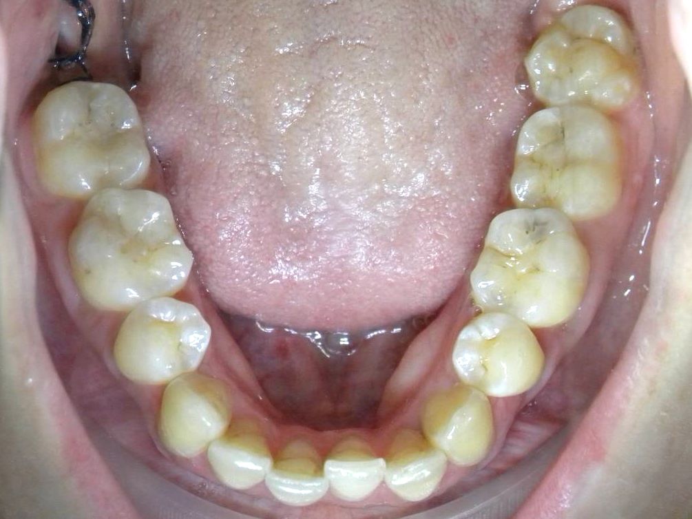 Oclusal Superior