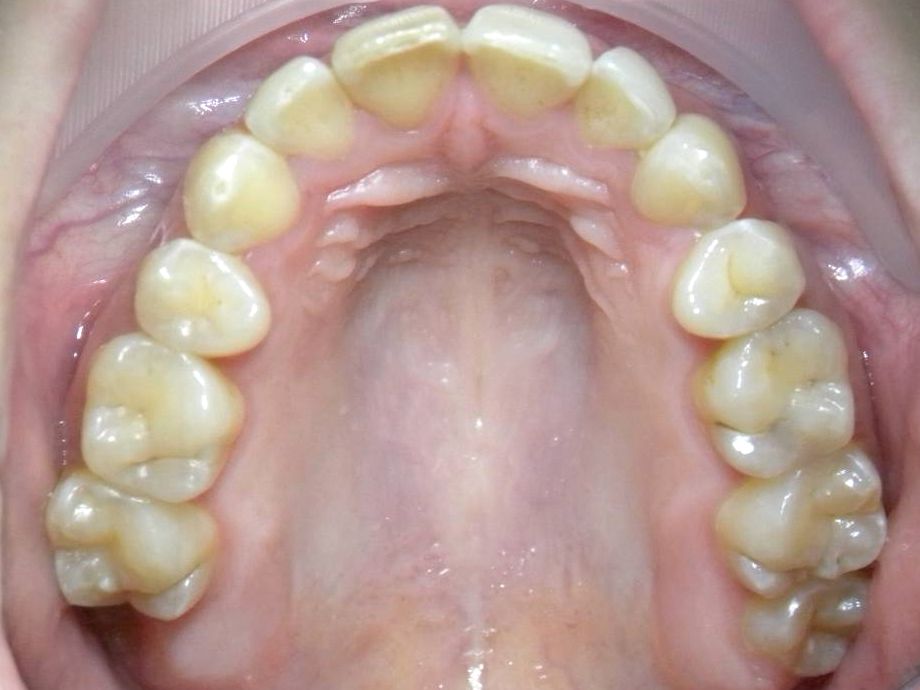 Oclusal Inferior