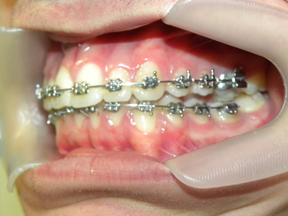 Lateral Izquierda